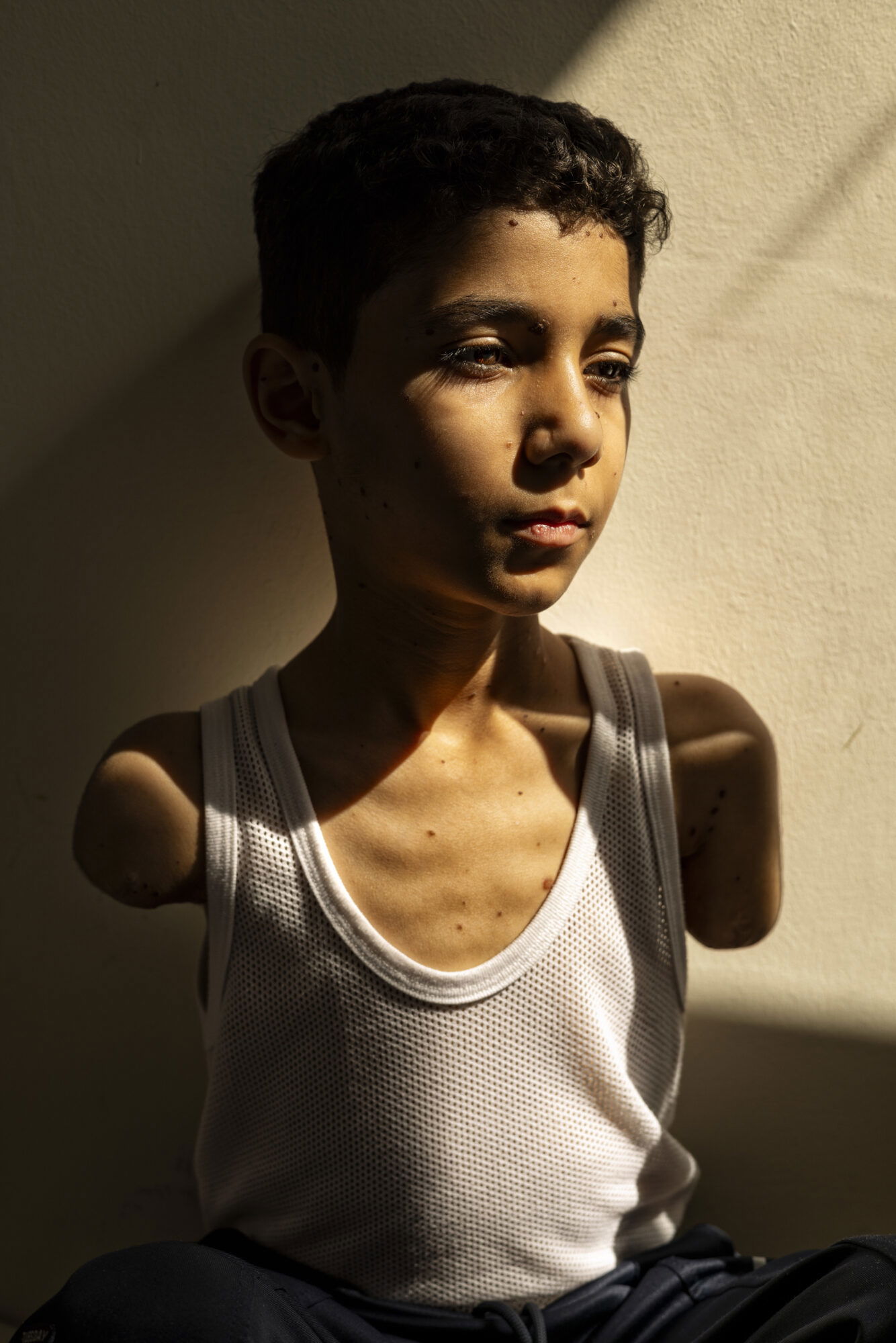 Mahmoud Ajour, 9 Jahre alt, verlor beide Arme nach einem israelischen Luftangriff in Gaza. © Samar Abu Elouf | für die The New York Times